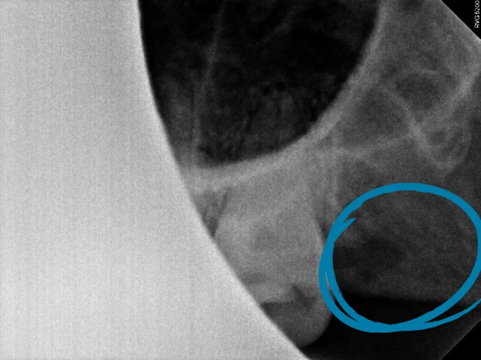 상악 좌측 사랑니 발치 후 치근단 사진