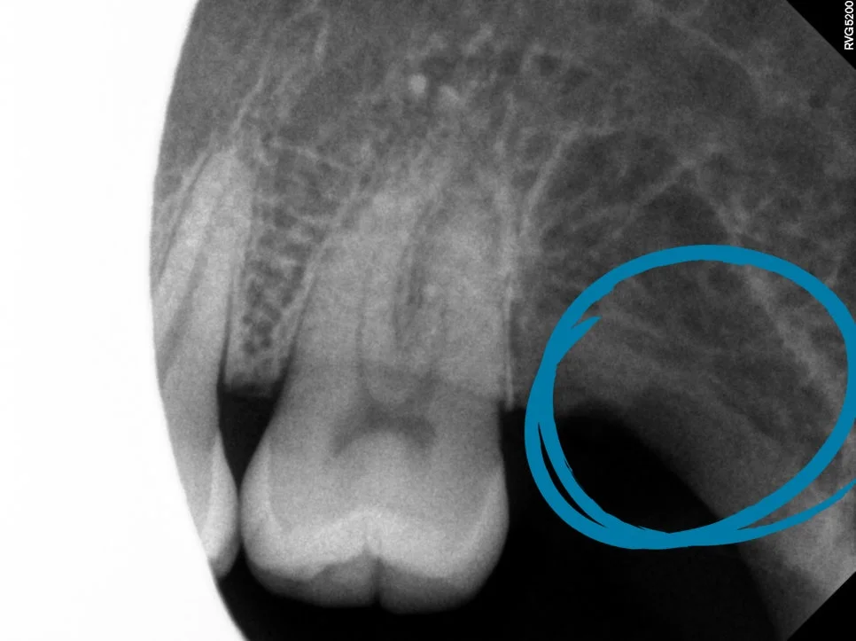 상악 우측 사랑니 발치 후 치근단 사진