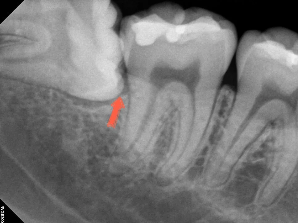 매복 사랑니 치근단 방사선 발치 진행