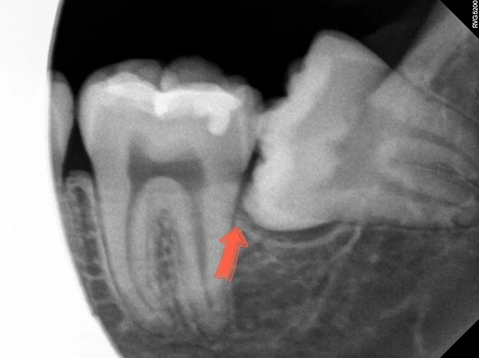 매복 사랑니 치근단 방사선 제2대구치 위협