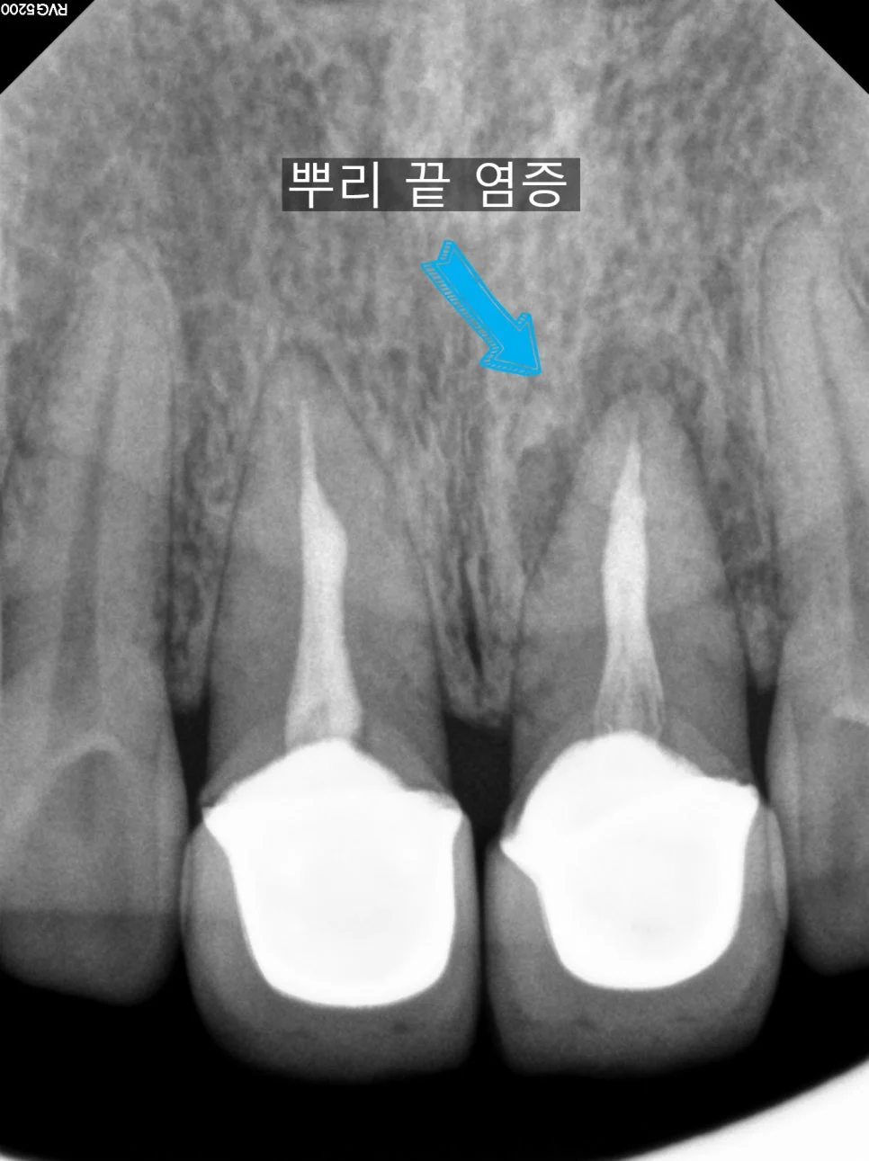 앞니 치근단 엑스레이 뿌리 끝 염증 소견