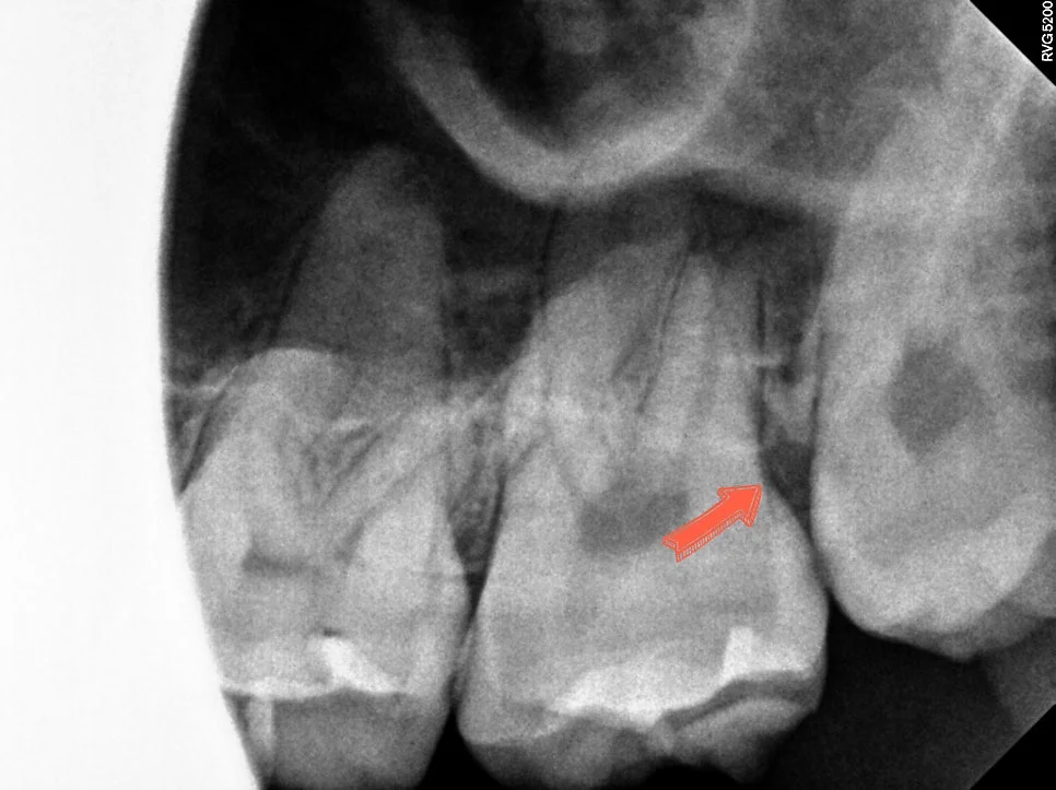 위 사랑니 충치 방사선 확인