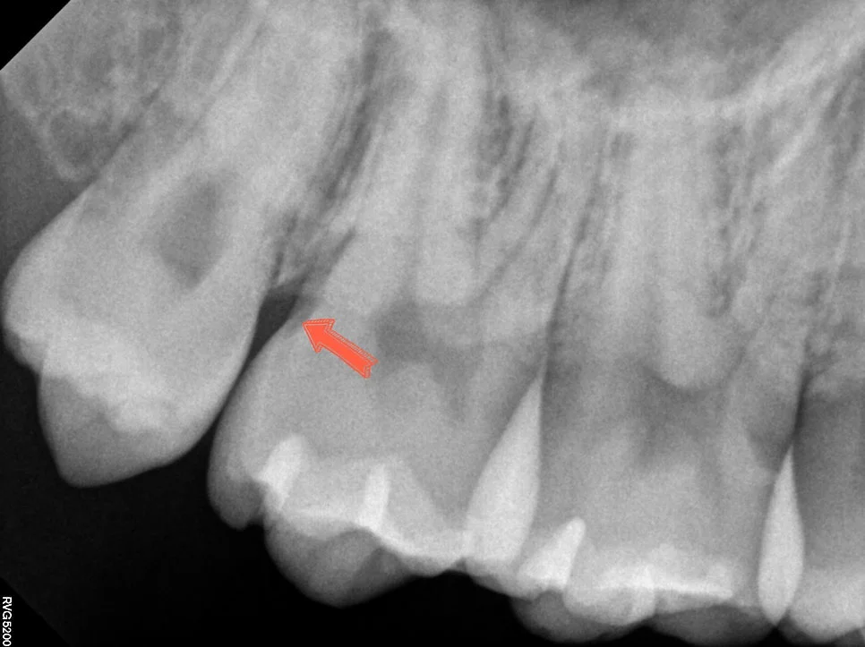 위 사랑니 대합치 없는 상태 방사선