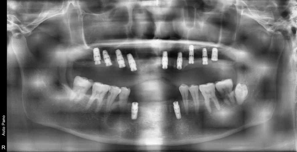 수술 후 파노라마 X-ray - 전악 임플란트 식립 완료