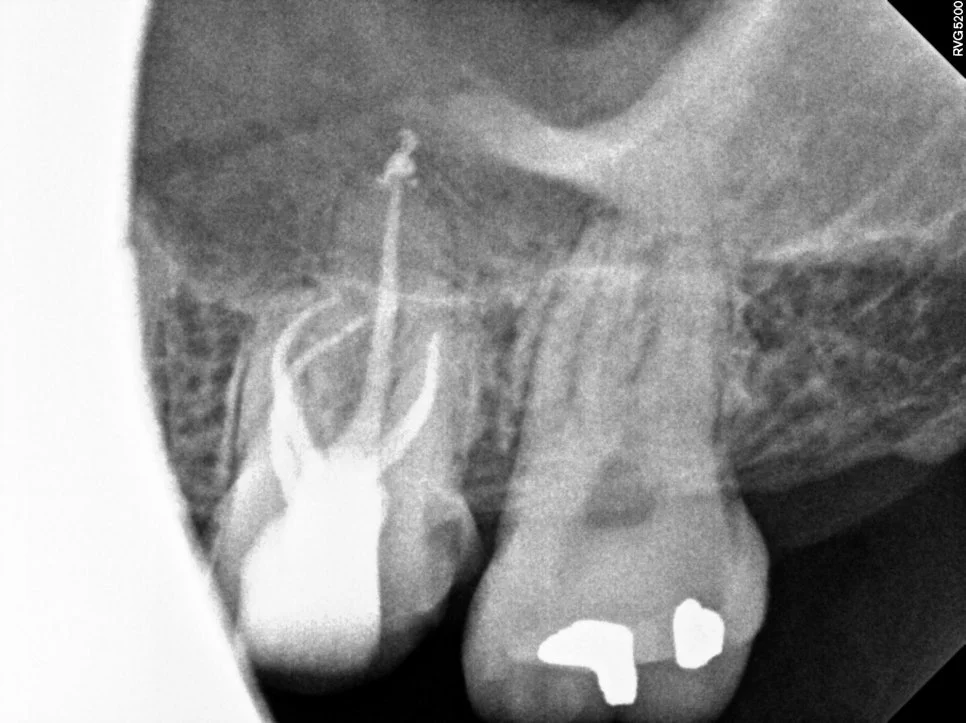 신경치료 후 코어 레진 수복 완료
