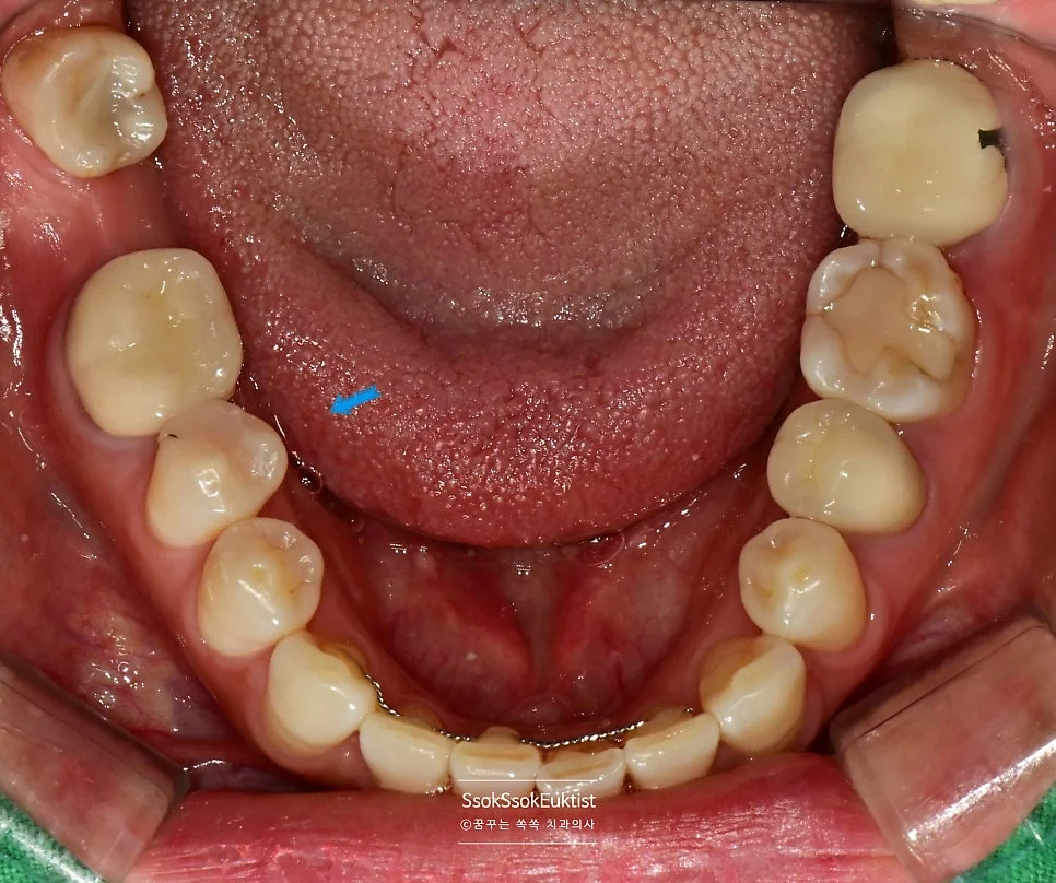 치료 완료 후 하악 구강 사진