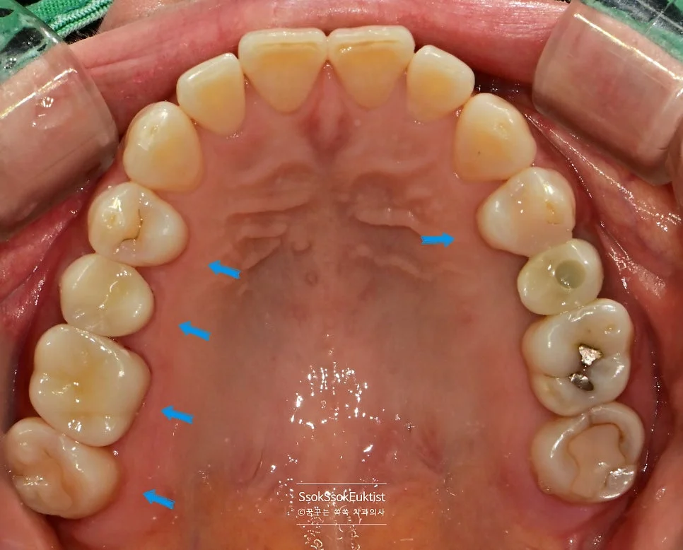 치료 완료 후 구강 정면 사진