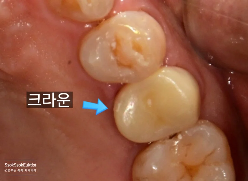 레진 코어 형성 후 크라운 장착 전 상태