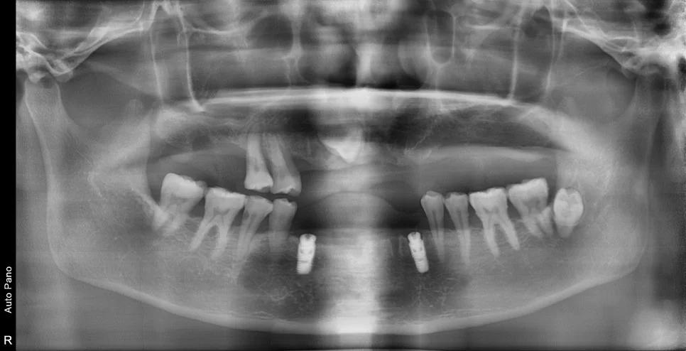 수술 전 파노라마 X-ray - 기존 임플란트와 잔존 치아