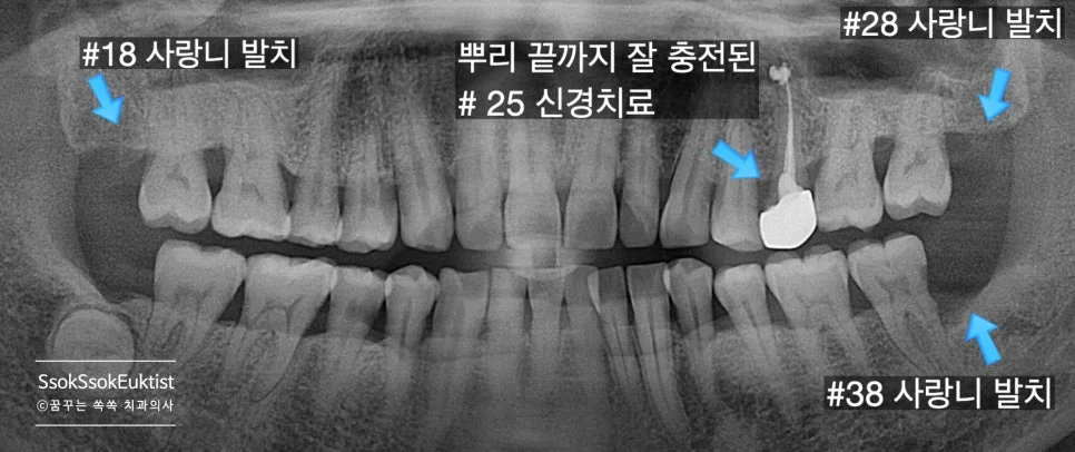 신경치료 사랑니 발치 회복 기간 설명 인포그래픽
