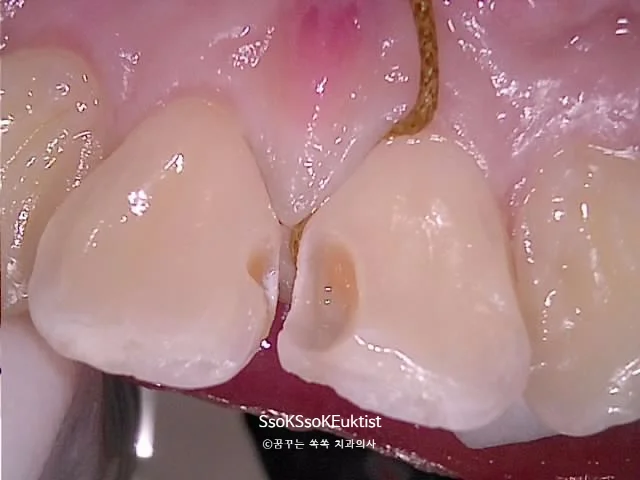 레진으로 앞니 형태 재건 과정