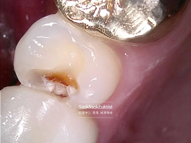 치료 중 발견된 충치 사진