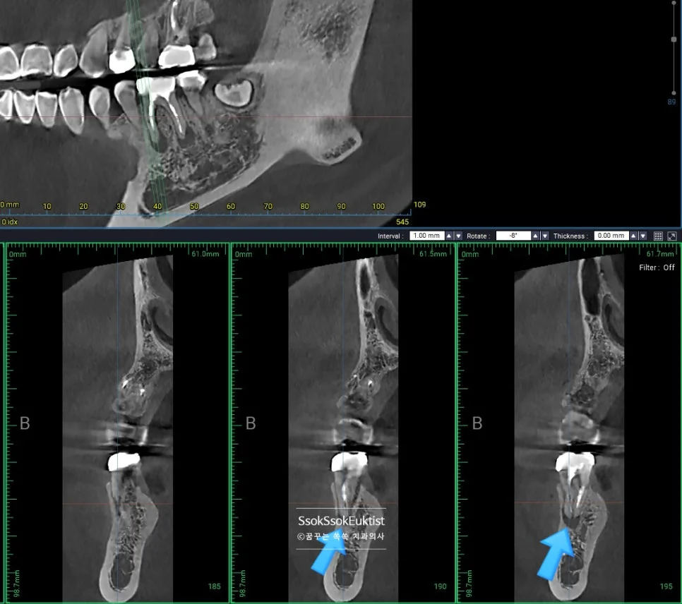 CBCT 3차원 영상 뿌리 끝 염증 확인