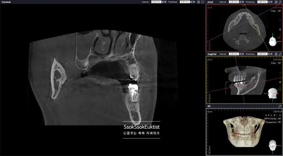 CBCT 3D CT 스캔 두 갈래 신경관 확인 재신경치료 진단