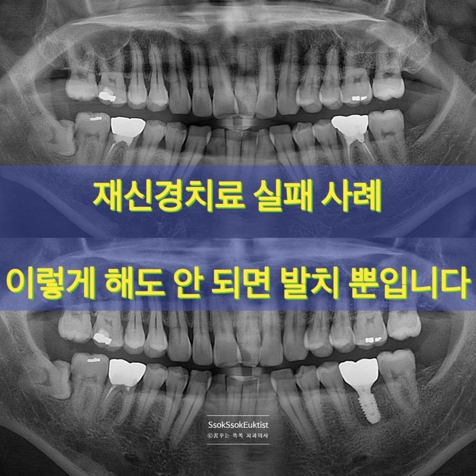 재신경치료 실패 사례 파노라마 X-ray 전체 구강 상태