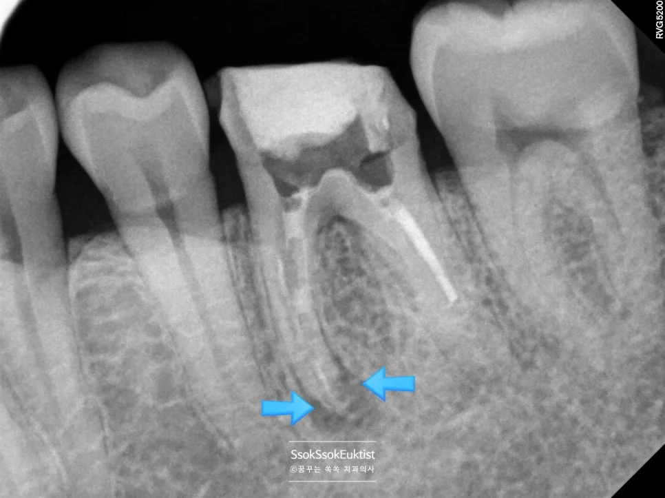 재신경치료 실패 원인 X-ray 신경관 외부 접근 불가 영역 화살표