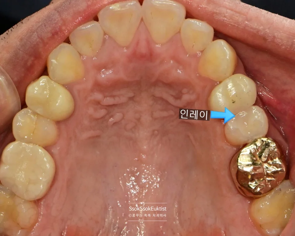 재신경치료 후 크라운 인레이 최종 결과 사진 1