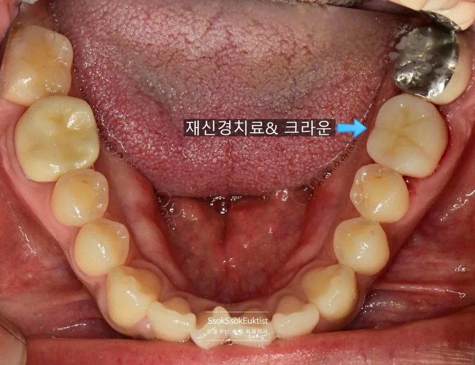 재신경치료 후 크라운 인레이 최종 결과 사진 2