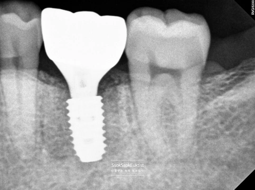 임플란트 최종 보철물 크라운 장착 X-ray