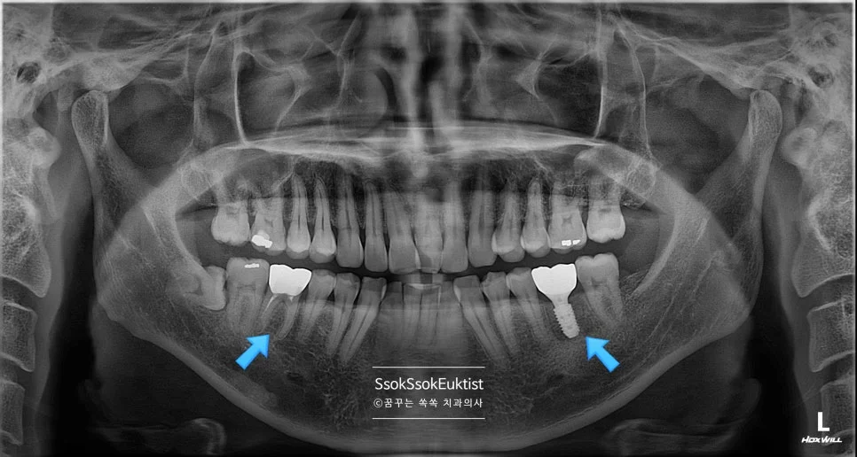 최종 파노라마 X-ray 임플란트 크라운 교체 모두 완료