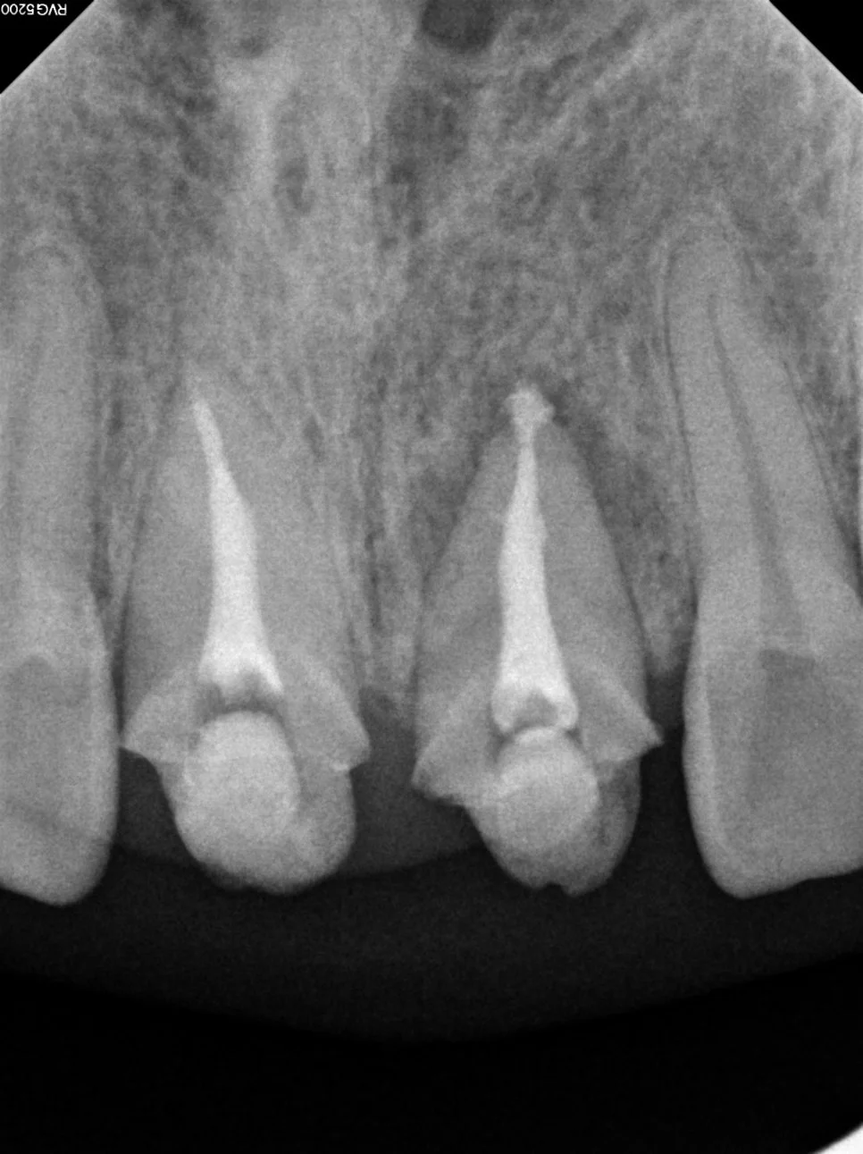 재신경치료 완료 후 최종 충전 엑스레이