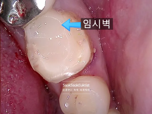 GI 글라스이오노머 임시벽 형성 완료