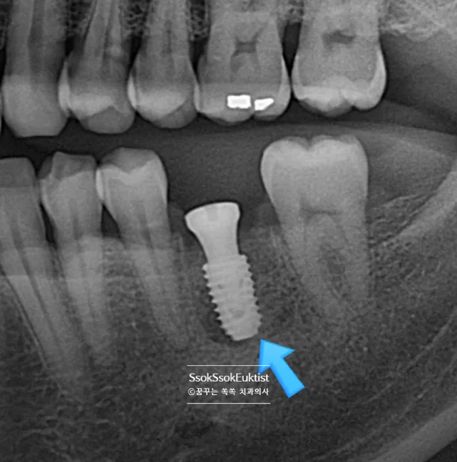 즉시 임플란트 식립 후 X-ray 뼈이식 확인