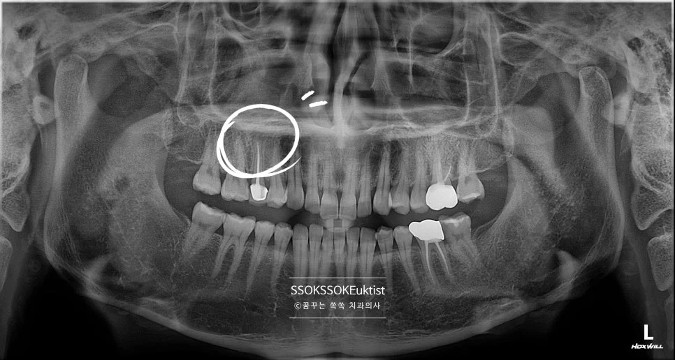재신경치료 파노라마 진단 우측 상악 치근단 병소