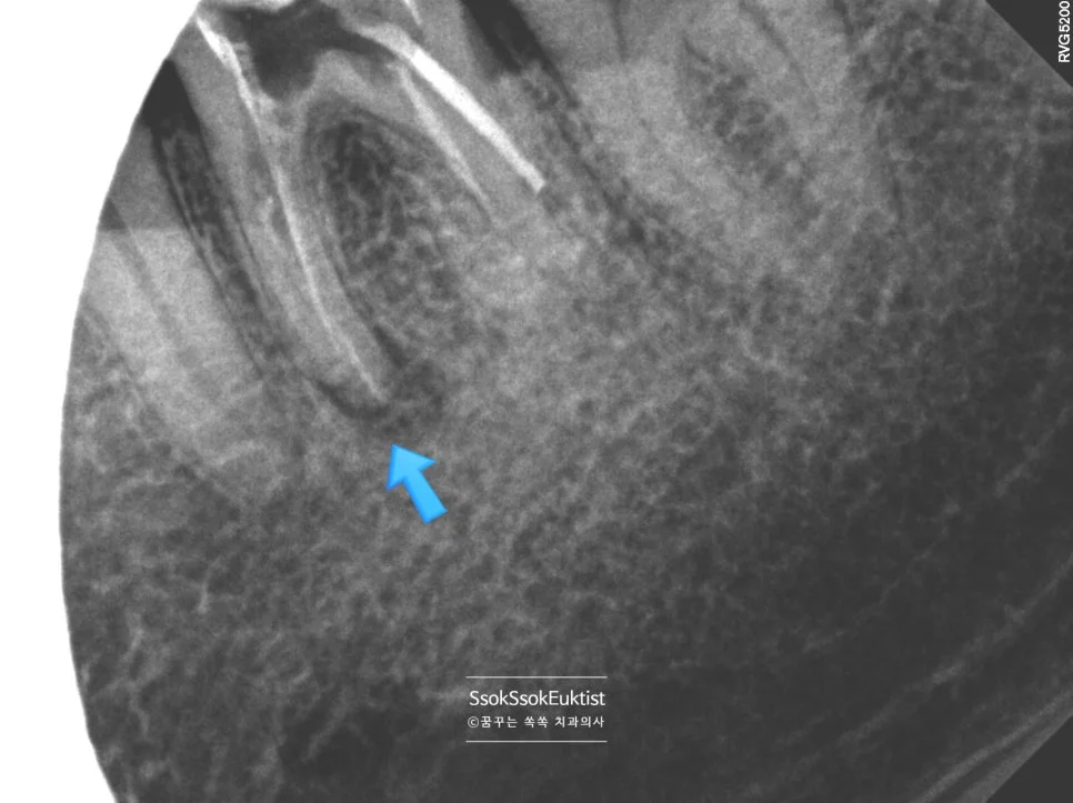 재신경치료 근관 치료 후 근첨부 X-ray 뿌리 끝 확인