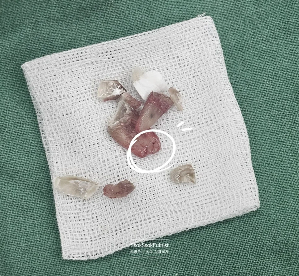 발치 후 근첨부 X-ray 뿌리 끝 염증 동그라미 표시