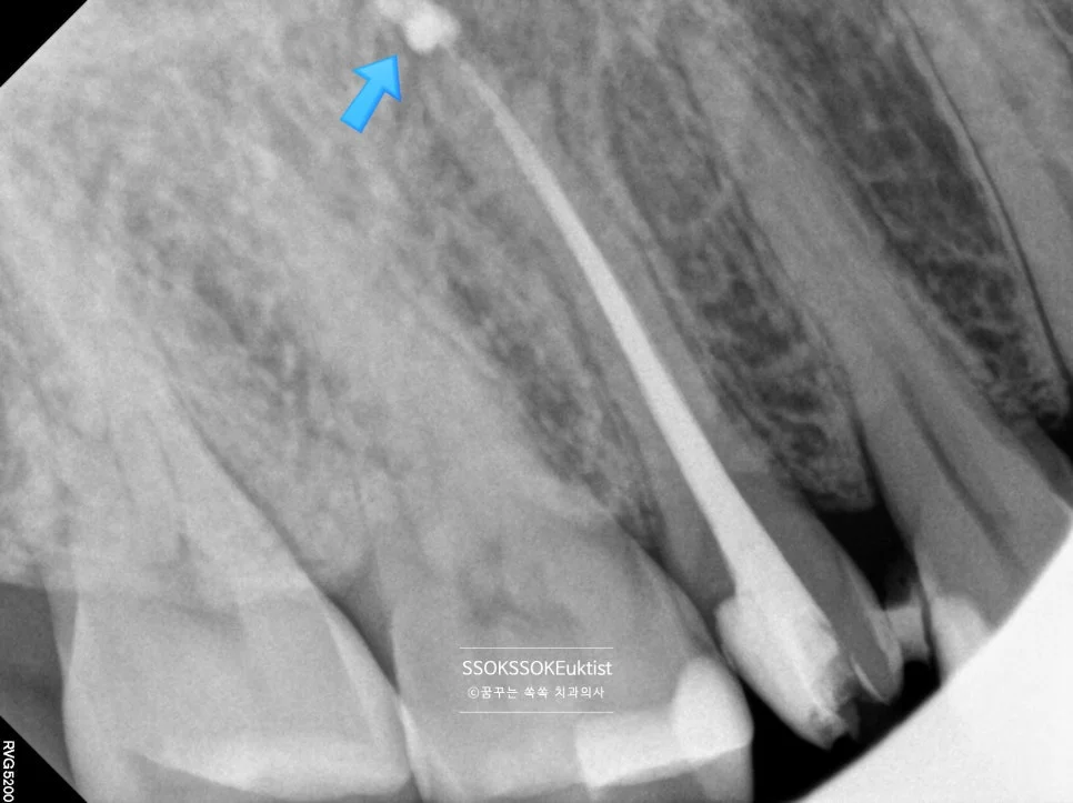 재신경치료 완료 X-ray 근관충전 Puff 확인
