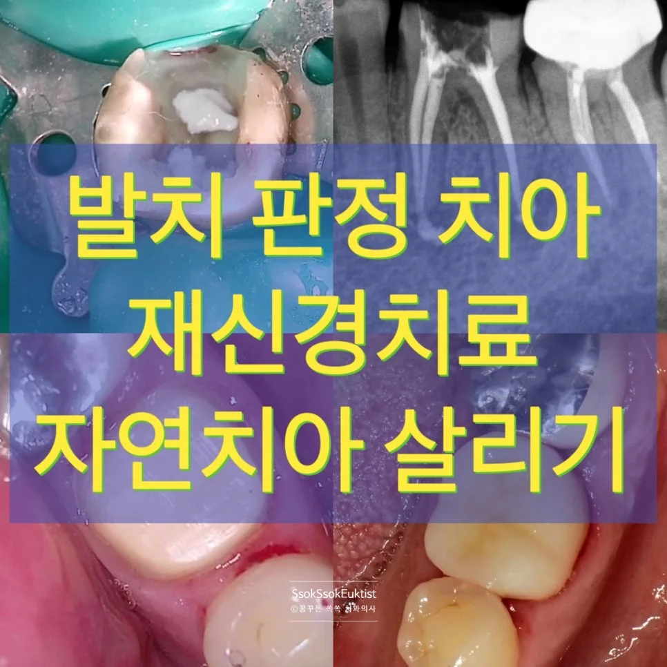 재신경치료 후기 인트로 복합 이미지 구강사진 엑스레이