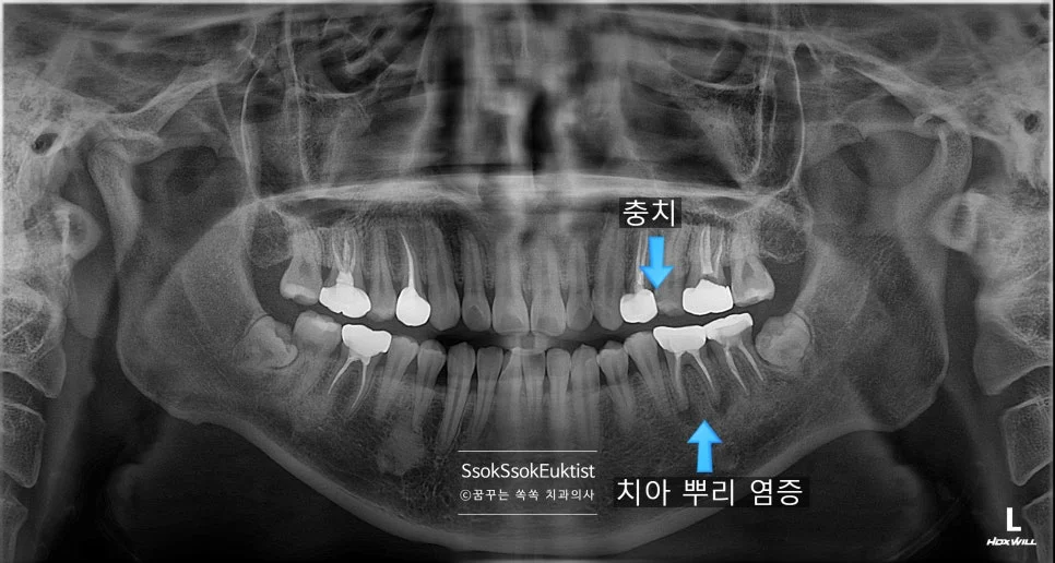 파노라마 엑스레이 문제 치아 화살표 표시