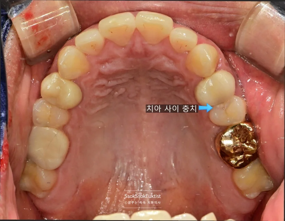 상악 구내사진 오래된 충전물 확인