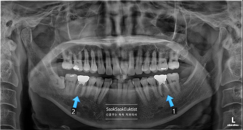 같은 위치 두 치아 비교 파노라마 X-ray 1번 통증 2번 무통