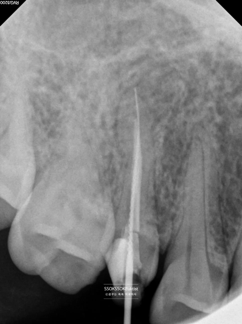 재신경치료 시술 중 근관 길이 측정 X-ray