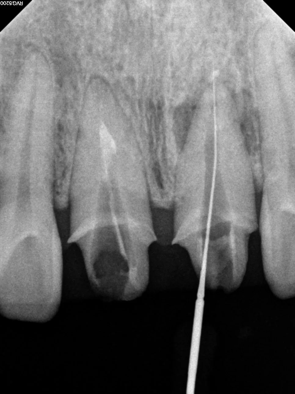 재신경치료 과정 중 신경관 확대 엑스레이