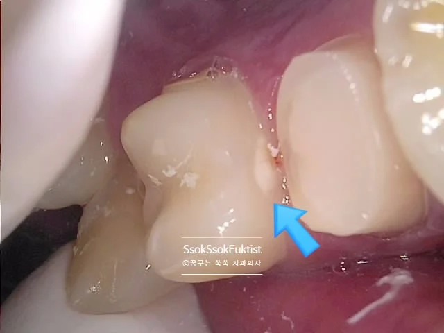 오른쪽 4번 인접면 충치 레진