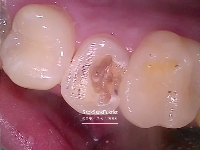 오른쪽 치료 전 구강 사진