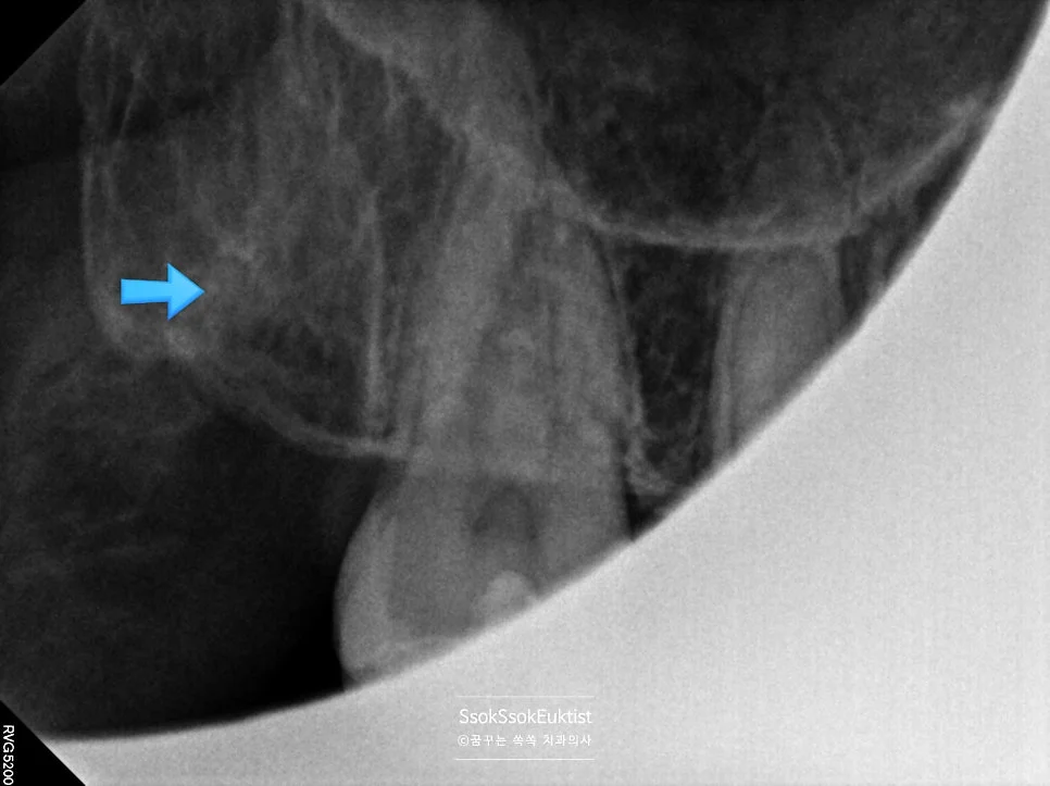 오른쪽 사랑니 발치 완료 1