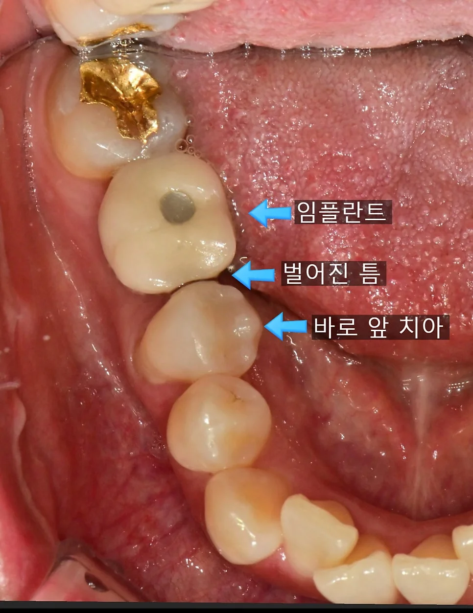 오른쪽 아래 임플란트와 자연치아 사이 틈 레이블 표시 사진