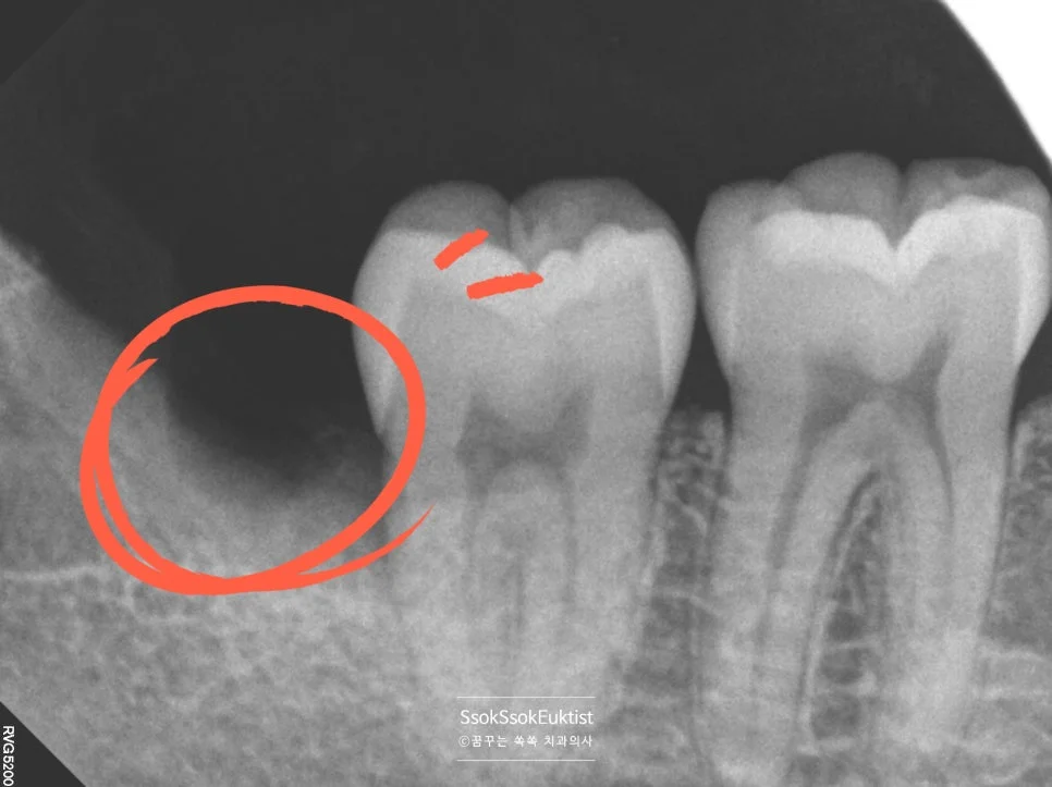 오른쪽 아래 매복 사랑니 발치 후 방사선