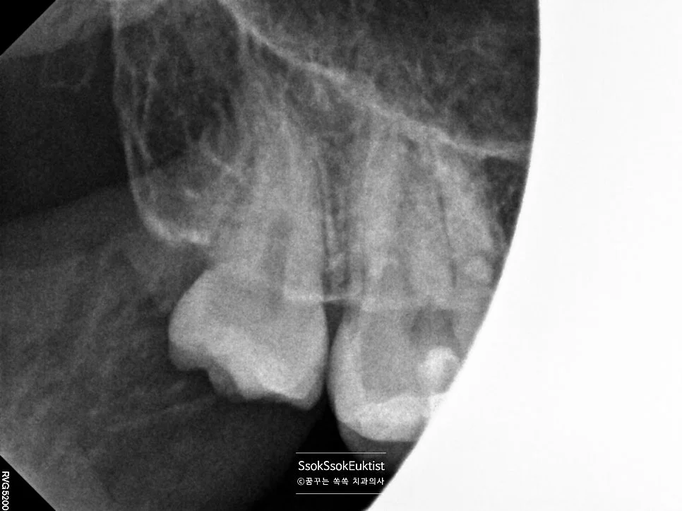 오른쪽 아래 사랑니 발치 과정