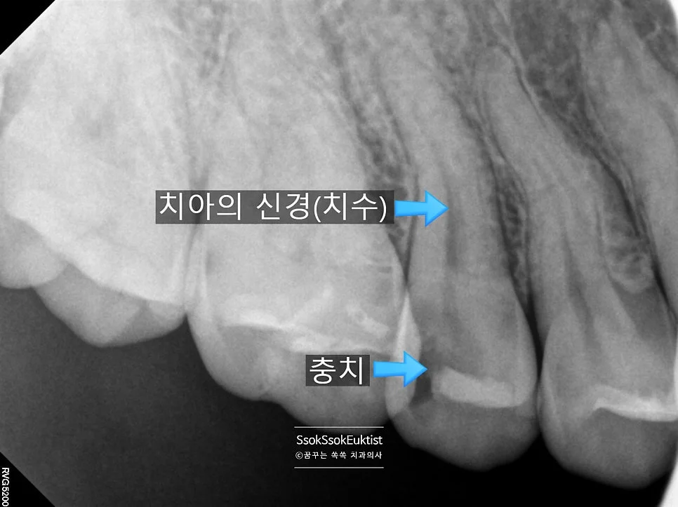 오른쪽 신경치료 방사선 진단