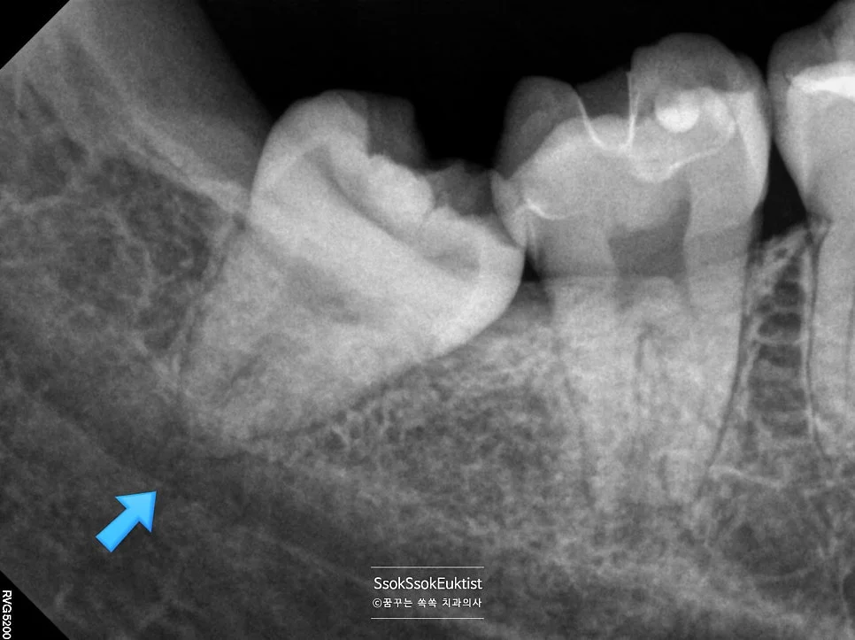 오른쪽 위 사랑니 발치 사진