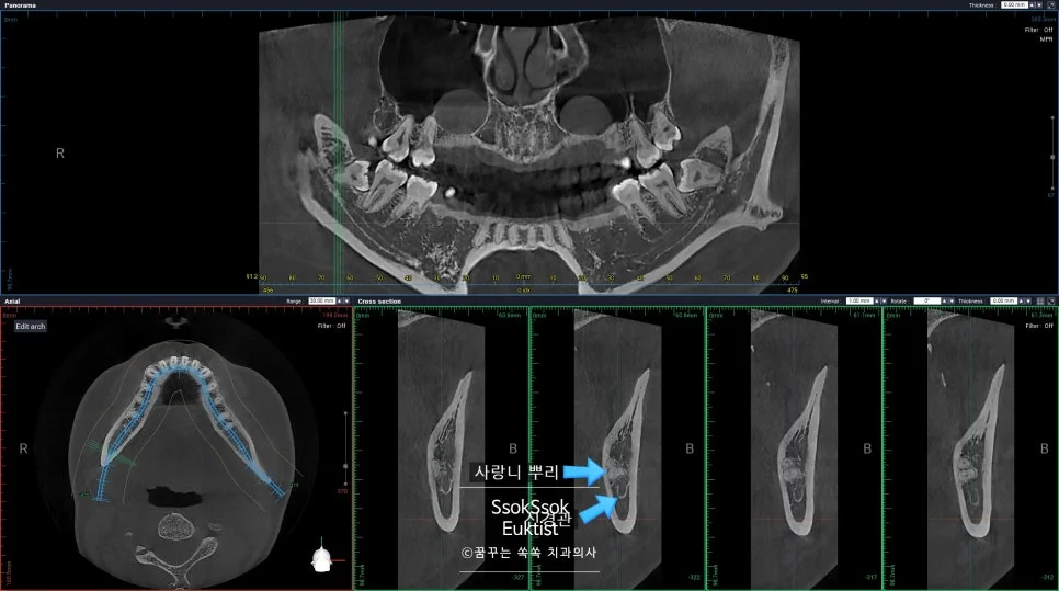 오른쪽 아래 사랑니 신경관 매우 인접 X-ray