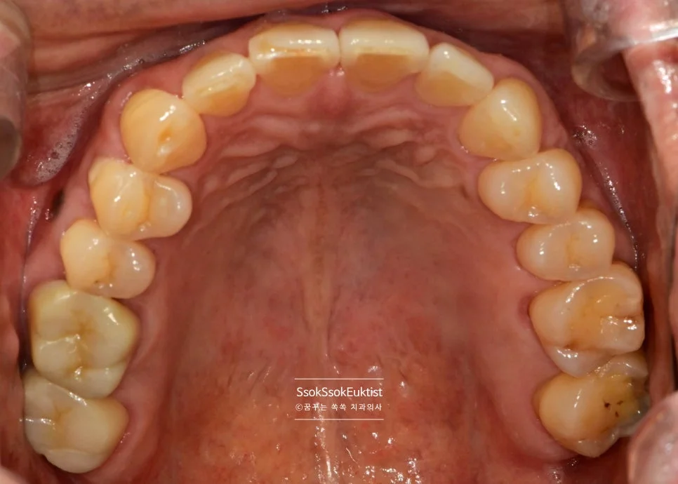 신경치료 전 상악 교합면 다수 보철 충전 확인