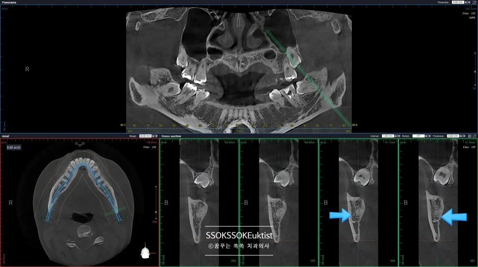 신경치료 케이스1 CBCT 치근단 병변 단면