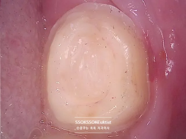 크라운 지대치 형성 잇몸 마진