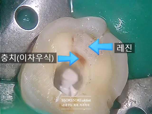 골드 인레이 제거 후 이차 충치 노출